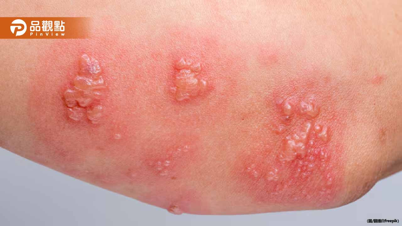 帶狀皰疹痛不欲生！醫曝高危險群：這些人最容易中招