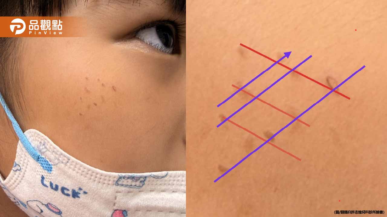 女童臉冒詭異紅疹!醫見「排太整齊」揪出恐怖真相 女童臉冒詭異紅疹!醫見「排太整齊」揪出恐怖真相