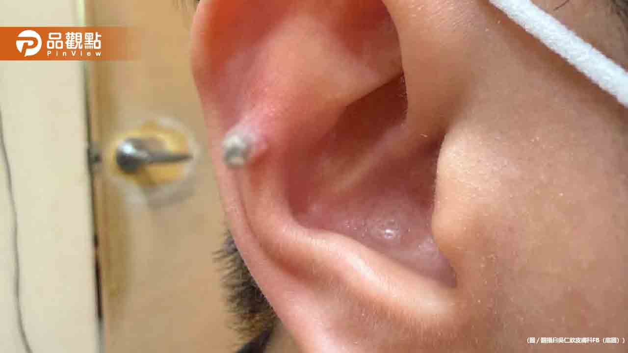 耳朵小傷口拖4年竟長出「肉柱」!醫驚:你要進化成獨角獸?