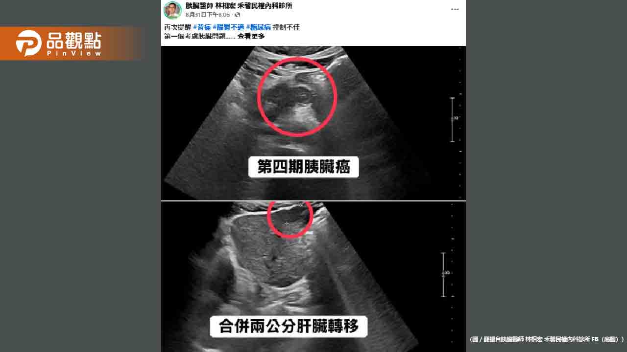 血糖失控竟是癌王警訊！50歲男確診胰臟癌四期已轉移肝臟